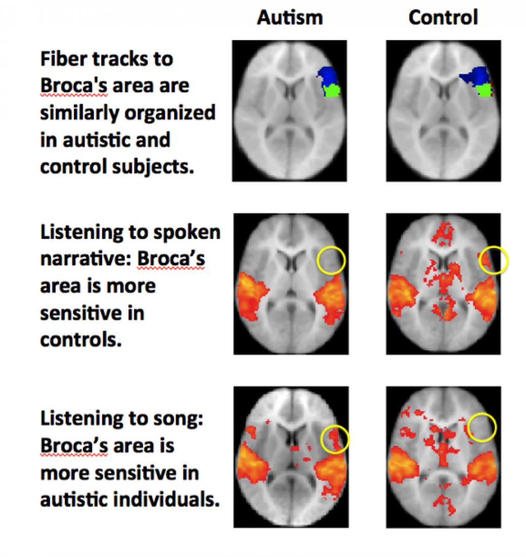 Neural Systems for Speech and Song in Autism Columbia University