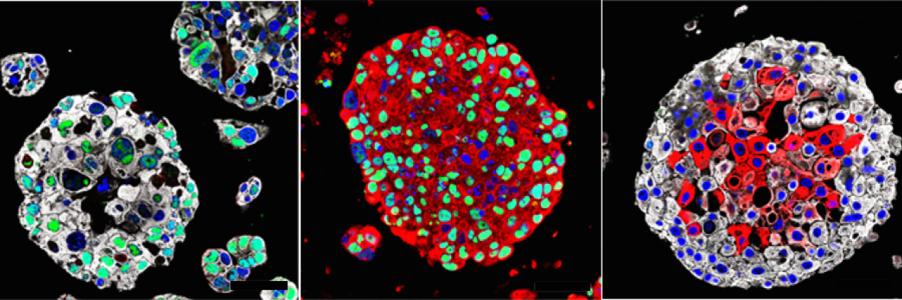 balls of cancer cells