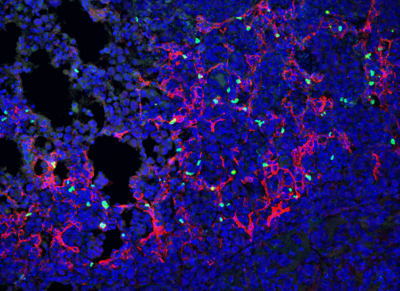 lung cells that protect tumors stained pink