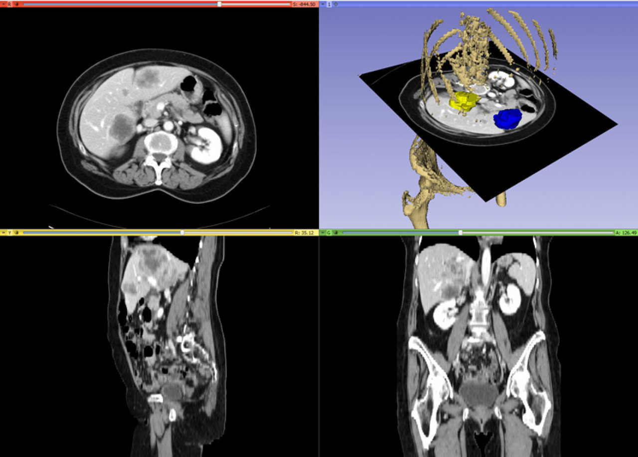 Cancer Imaging Radiologists Developing Better Ways to Track Tumors