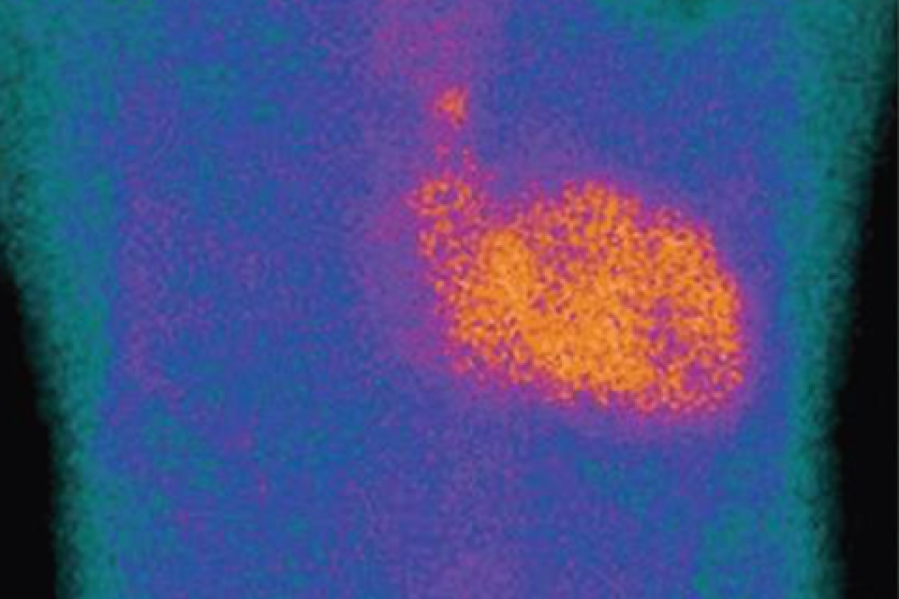 medical scan showing heart has accumulated transthyretin amyloid