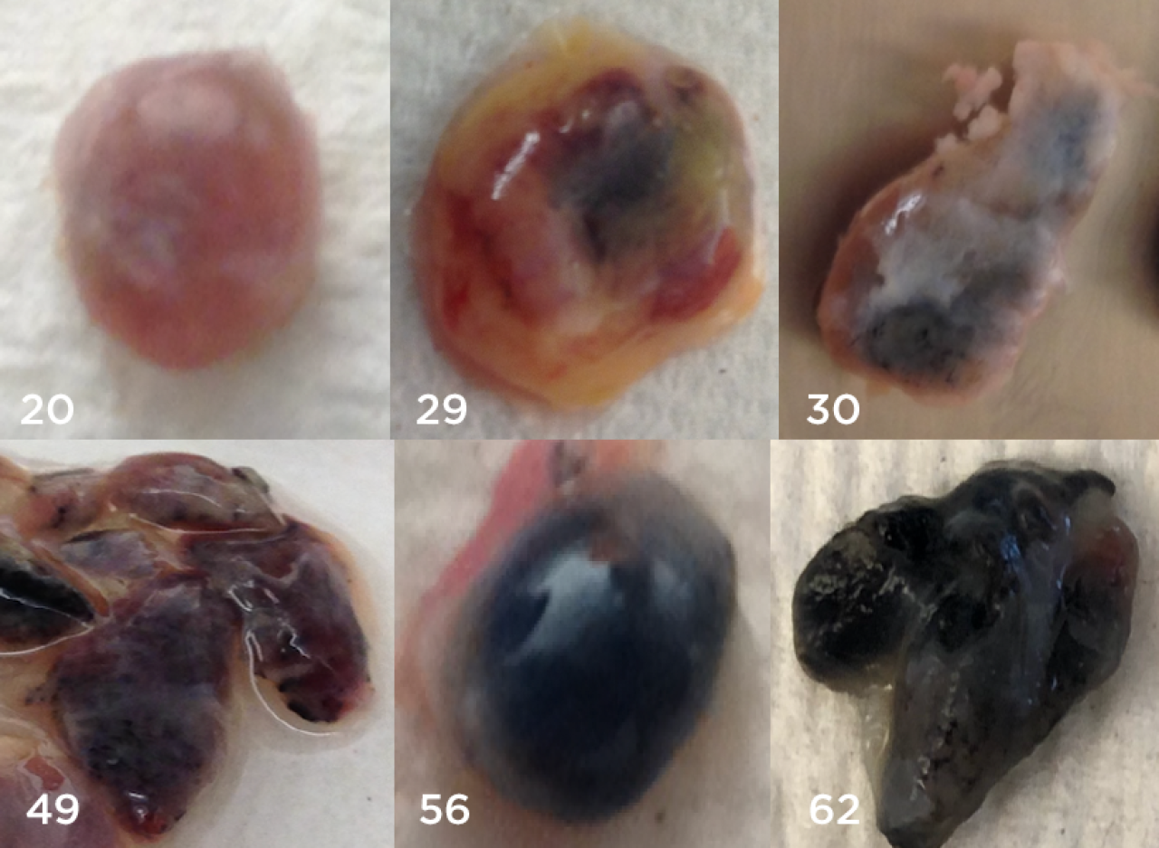 lymph nodes from the lungs get darker with increasing age