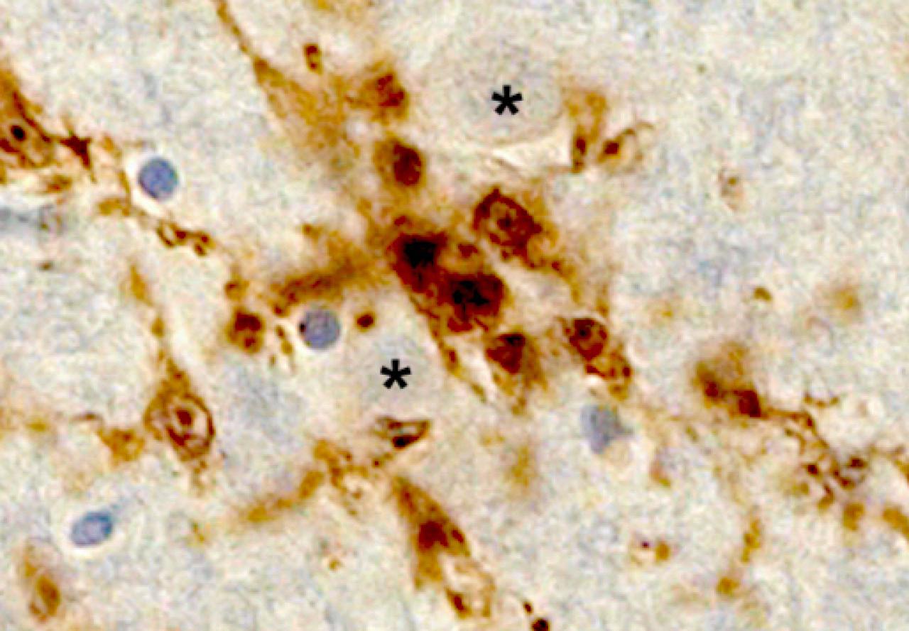 microglia nodule in the brainstem of a COVID patient