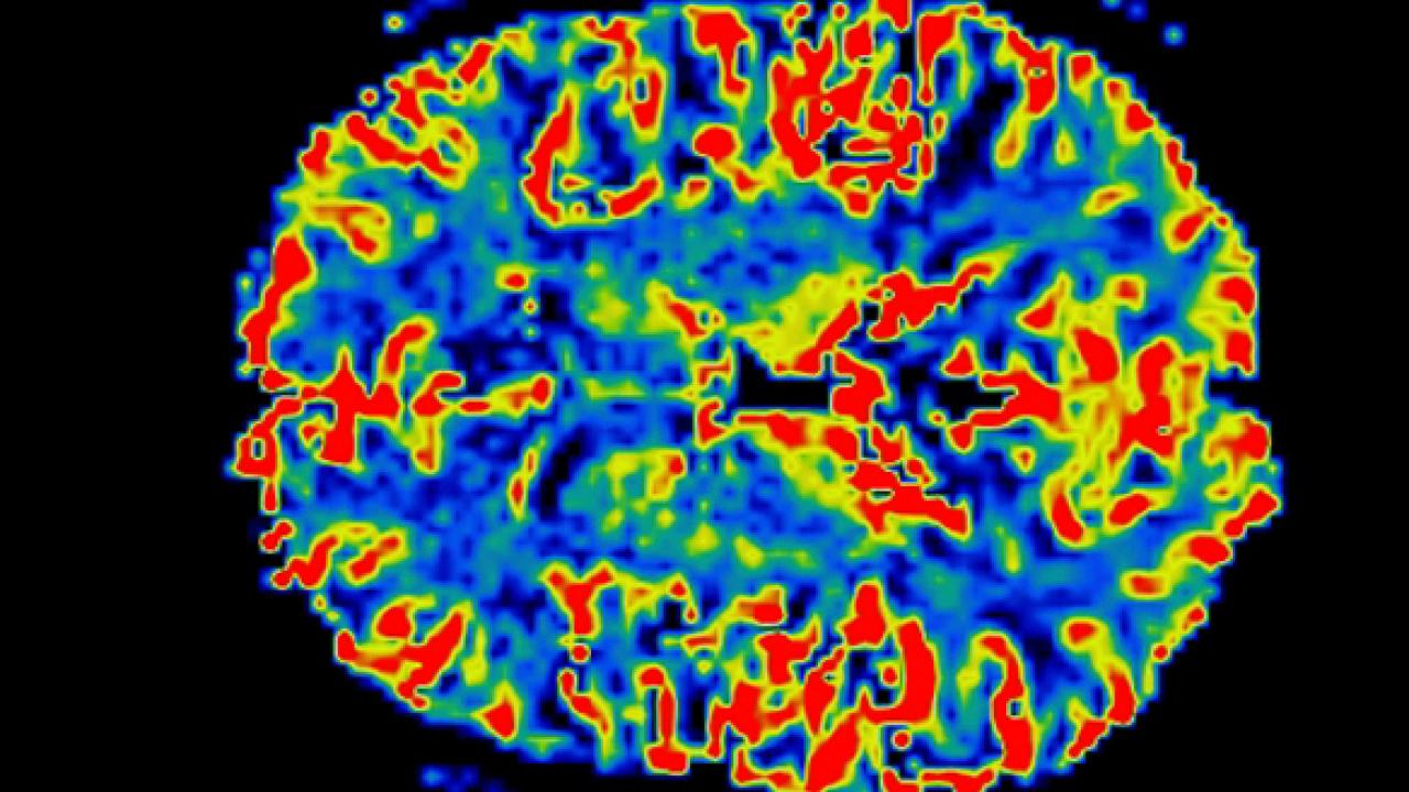 Is Parkinson's an Autoimmune Disease? Columbia University Irving