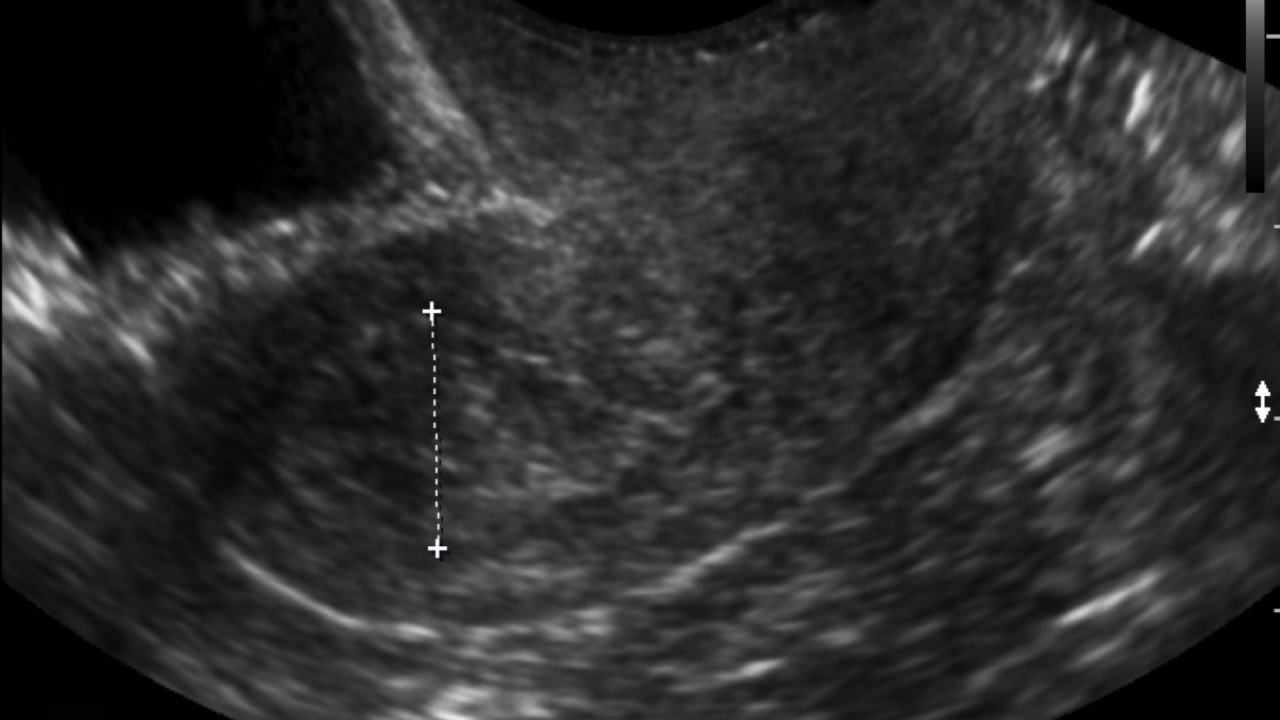 Study Examines Presence of Uterine Cancers at Time of Morcellated ...
