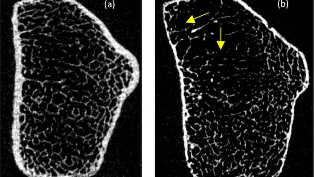 Rare Form Of Osteoporosis Around Pregnancy Gets Spotlight At