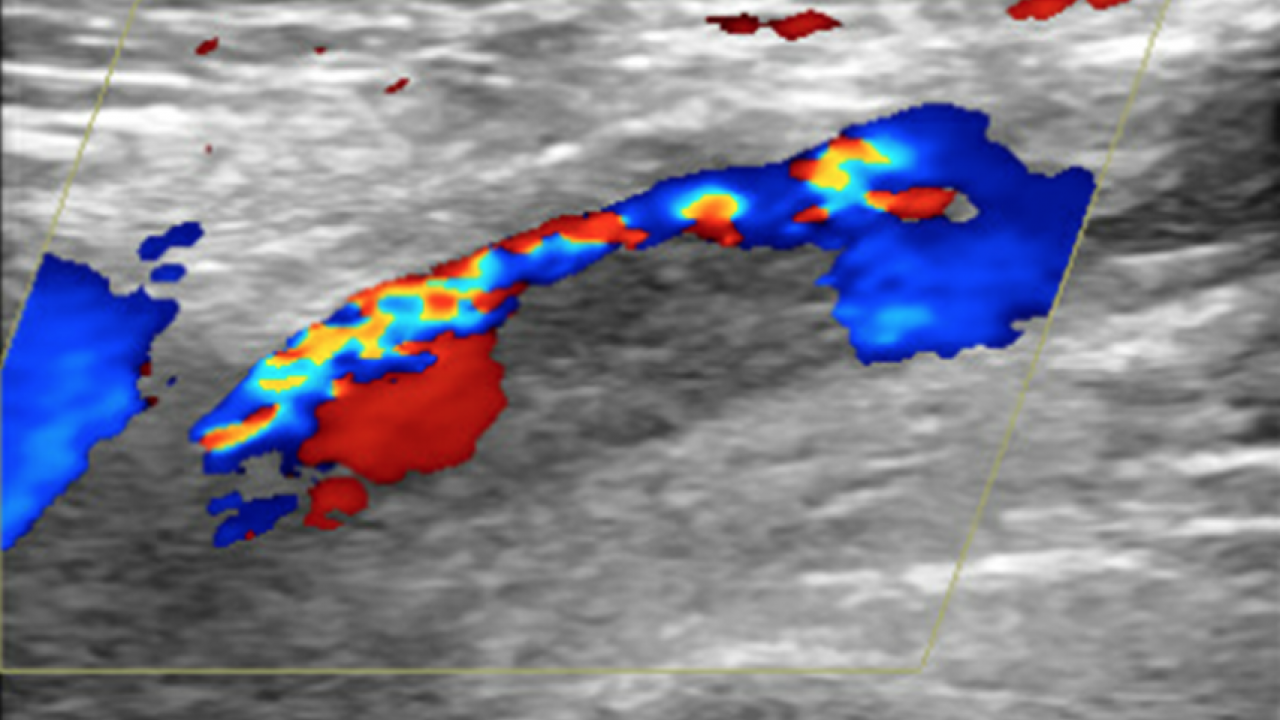 Thrombosis Emerges As Significant Risk For Covid 19 Patients