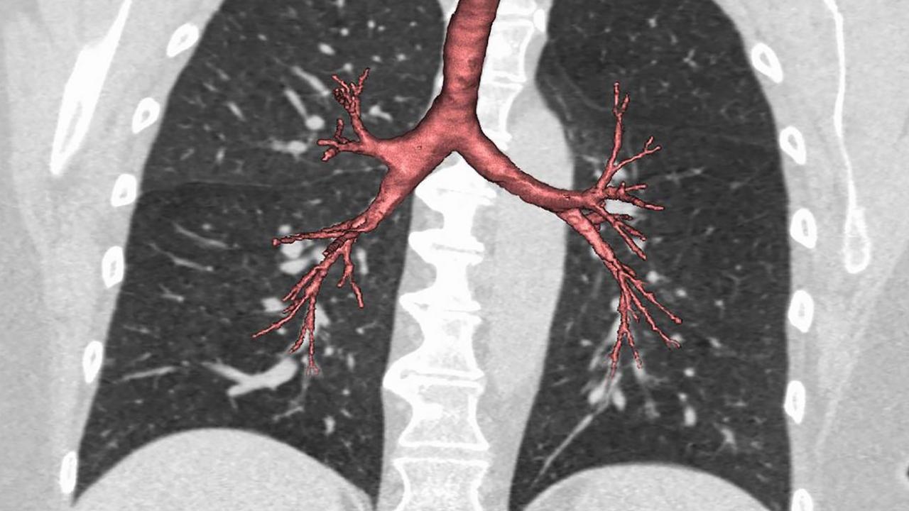 Undersized Airways May Explain Why Nonsmokers Get COPD | Columbia ...