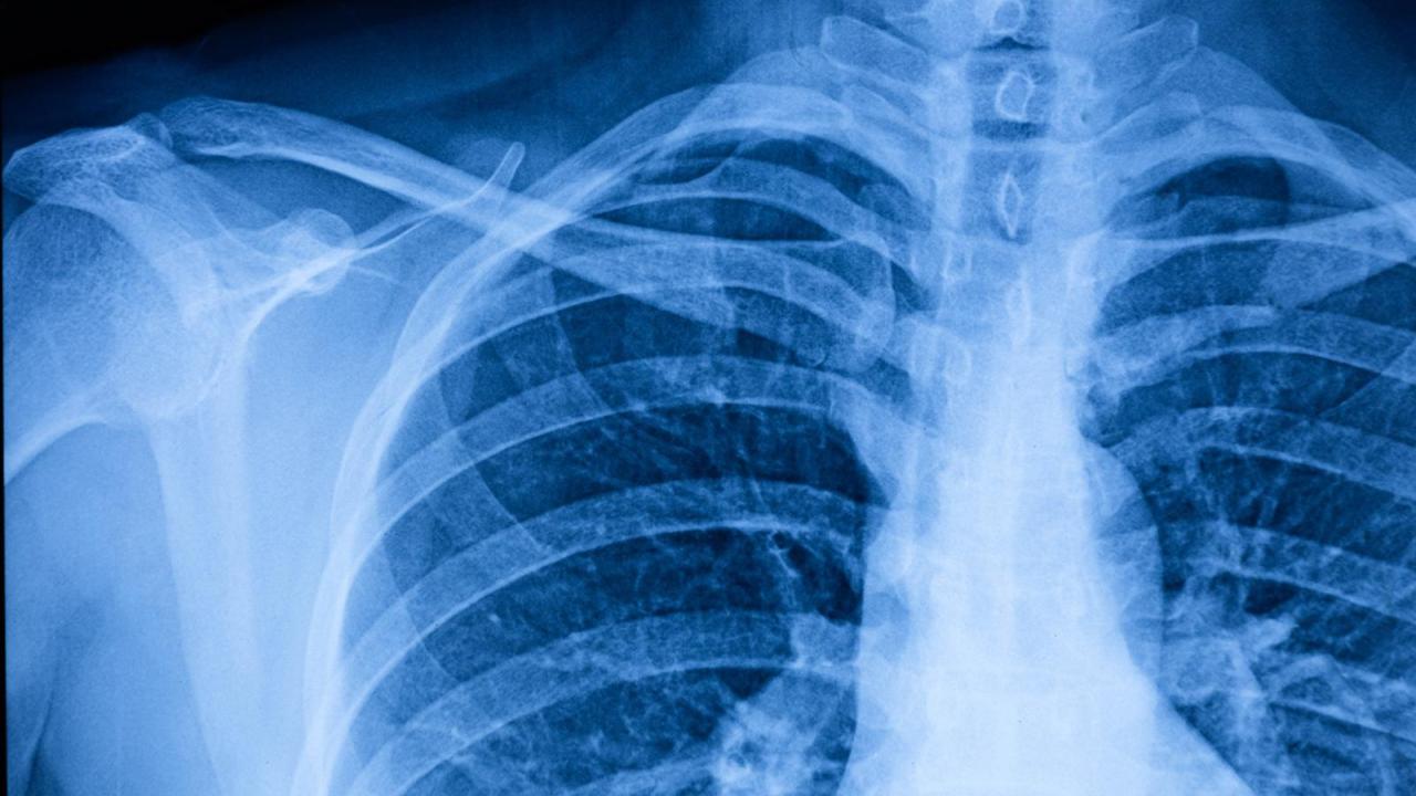 Study Questions Widely Used Race-Based Formula to Define Lung Disease - Vimarsana News