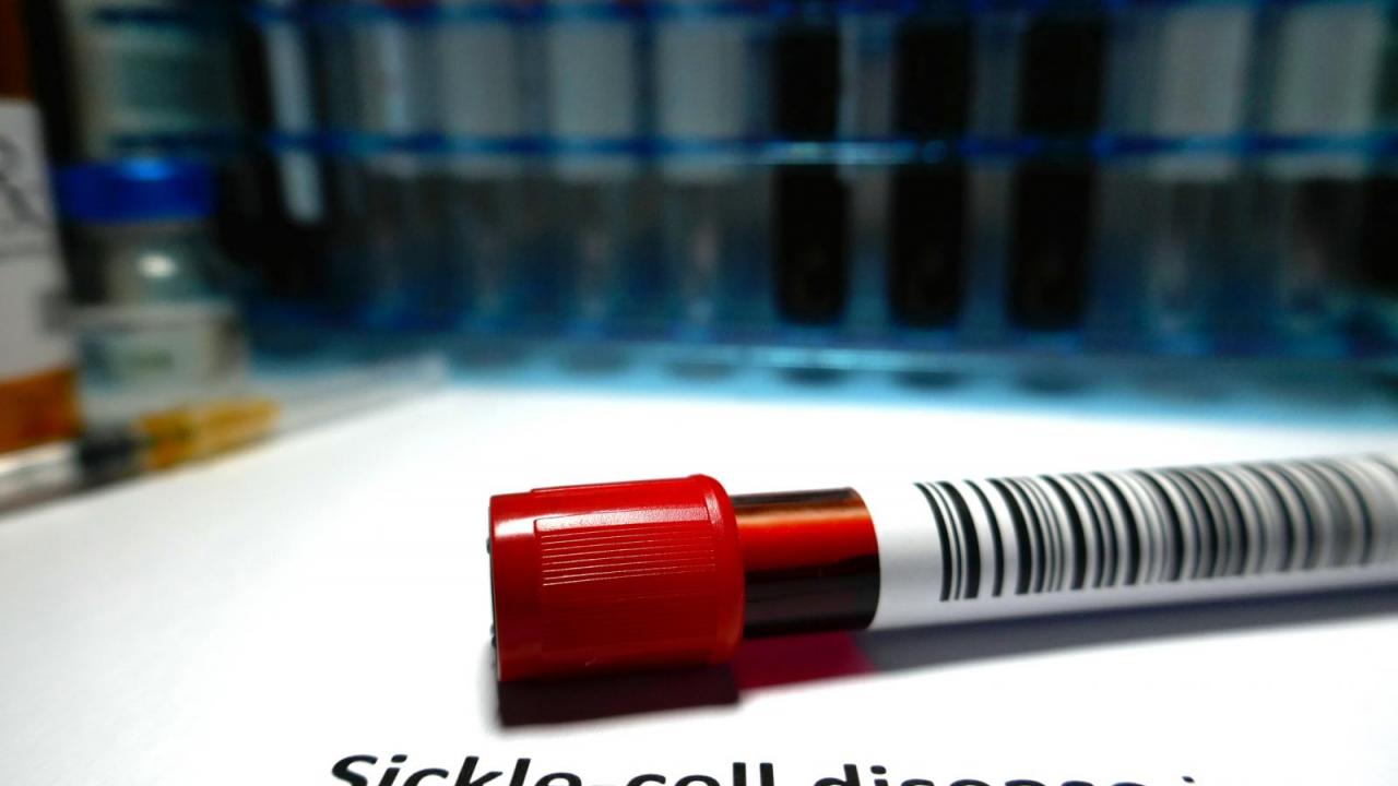 Experimental Gene Therapy Reverses Sickle Cell Disease for Years - Vimarsana News