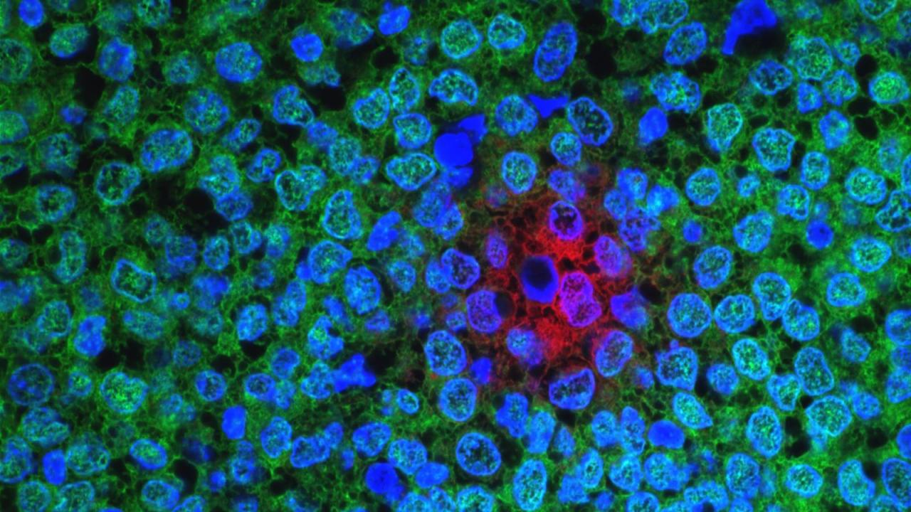 遺伝性乳がんの治療を改善する方法を示唆する研究