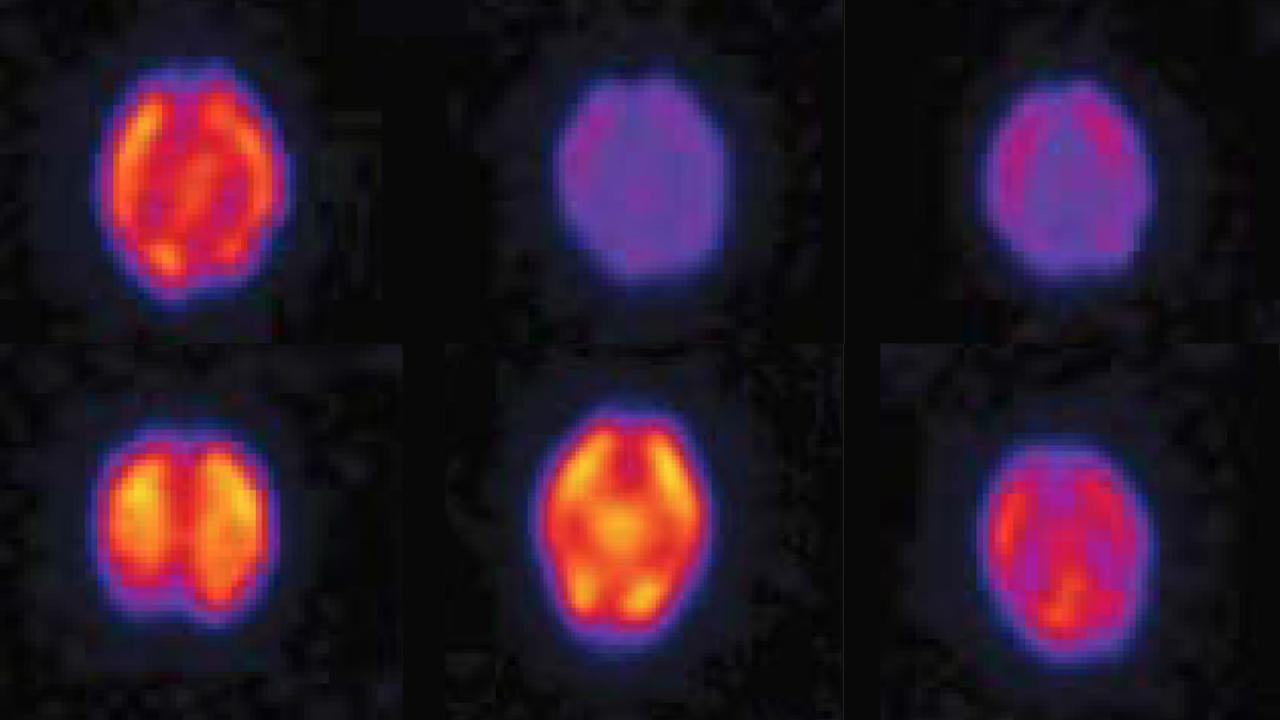 How Heart Failure Leads to Cognitive Decline Columbia University