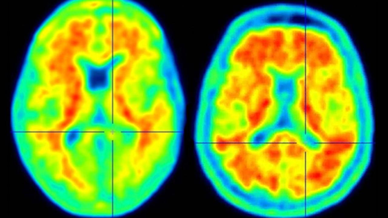 Newly Found Genetic Variant Defends Against Alzheimer’s Disease