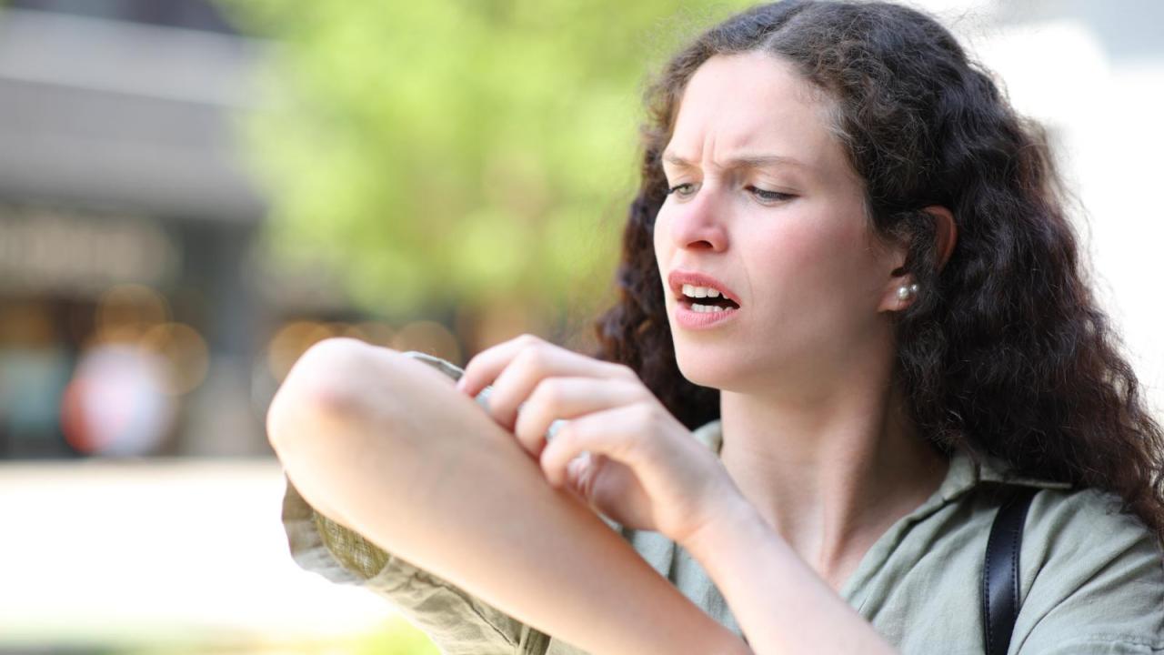 How to Stop Bug Bites from Itching | Columbia University Irving Medical ...