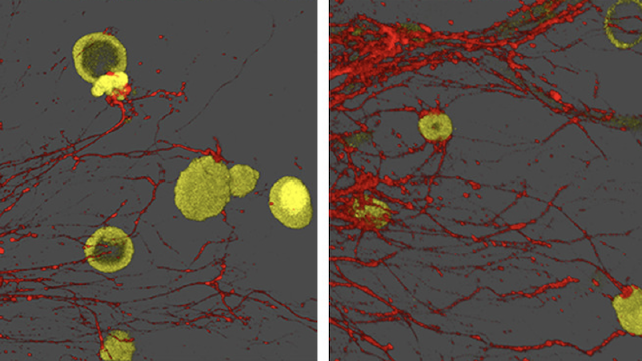 Nerves Electrify Stomach Cancer, Sparking Growth and Spread