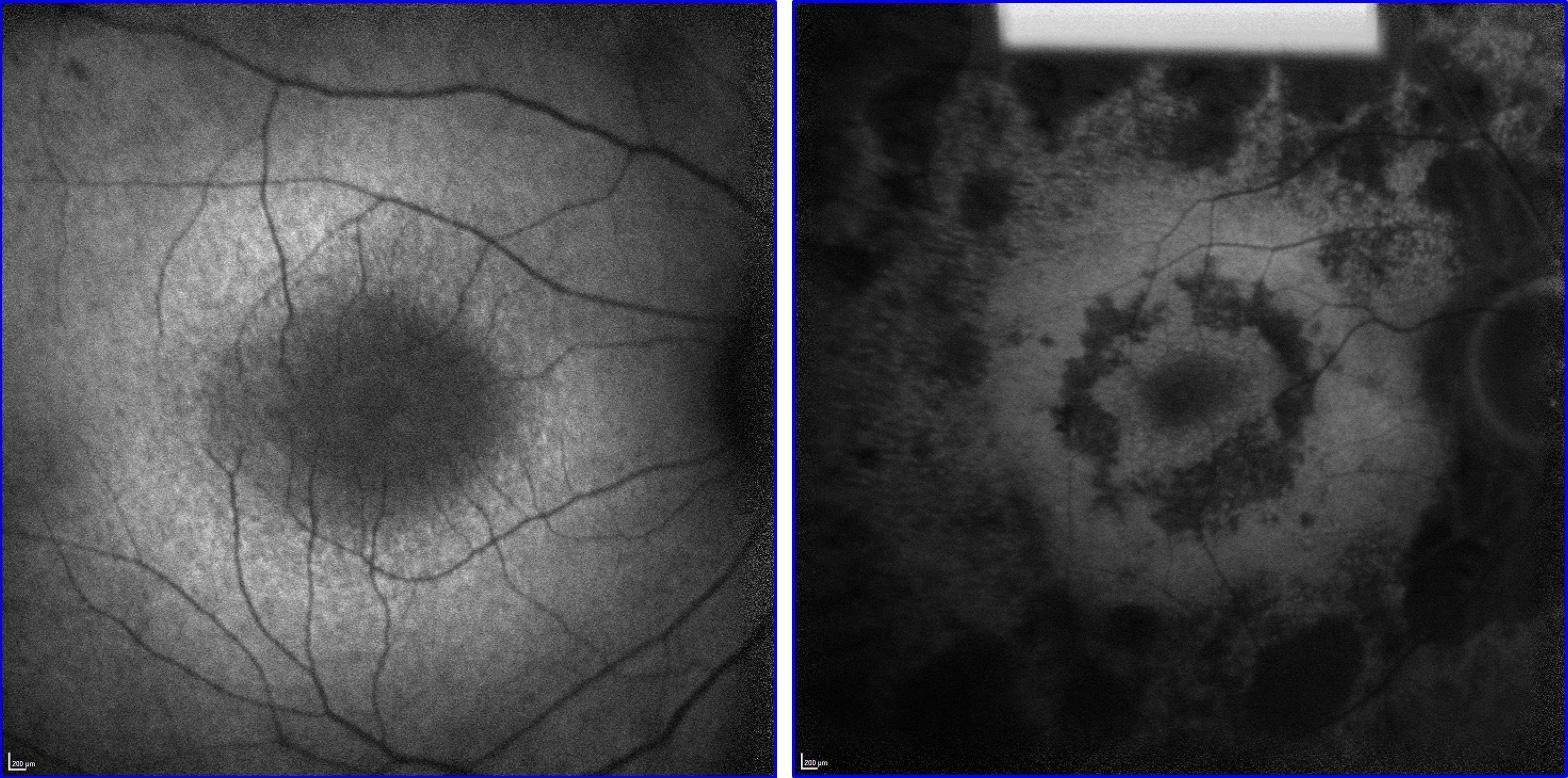 two images showing different stages of retina degeneration in patients with retinitis pigmentosa
