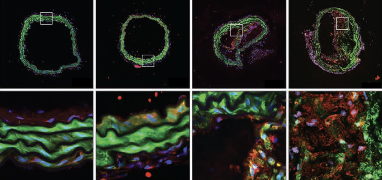 cross sections of arteries with varying degrees of atherosclerosis