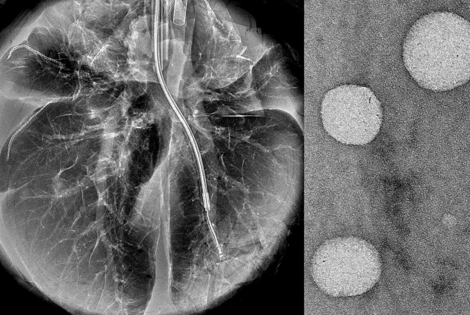 catheter in lung and nanoparticles