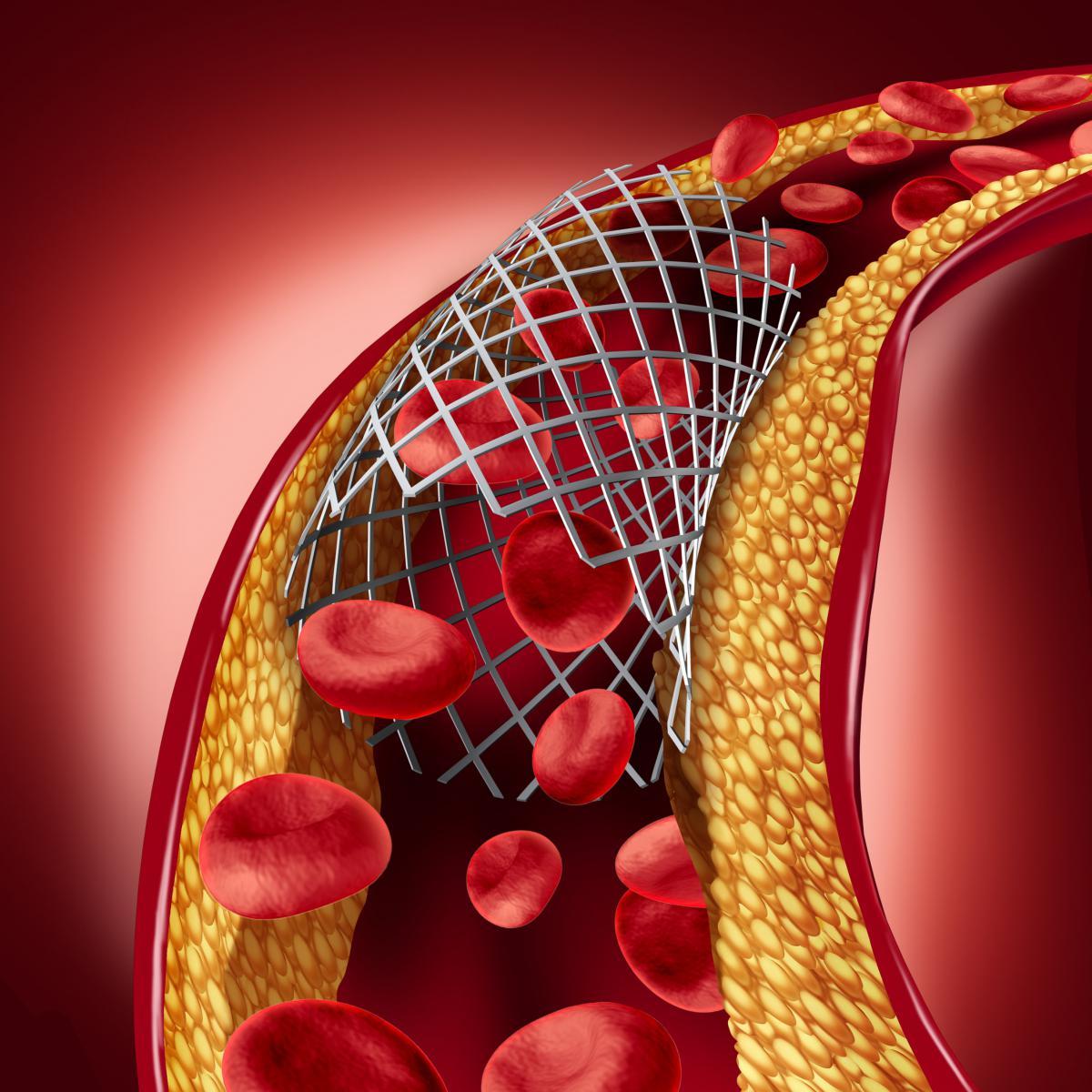 Stents, Bypass Equally Safe & Effective For Many With Left Main Heart