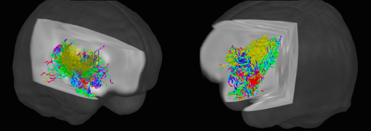 Do Antidepressants Taken During Pregnancy Affect the Fetal Brain