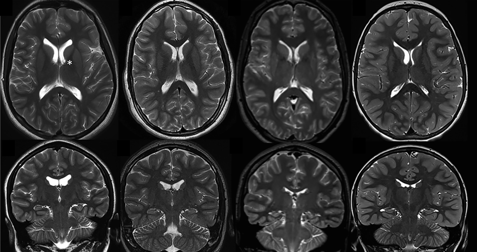 More Epilepsy Cases Linked to the Mosaic Brain Columbia University