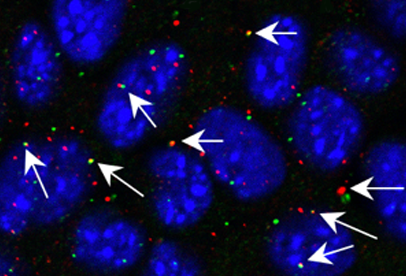 image of ERVs and ADAR1 expression in esophageal cancer organic