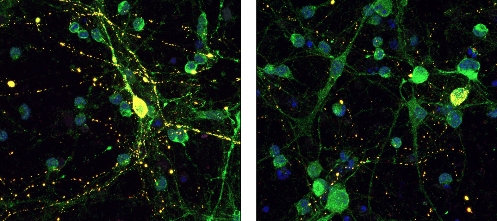 neurons with tau proteins; neurons treated with a peptide have fewer tau proteins