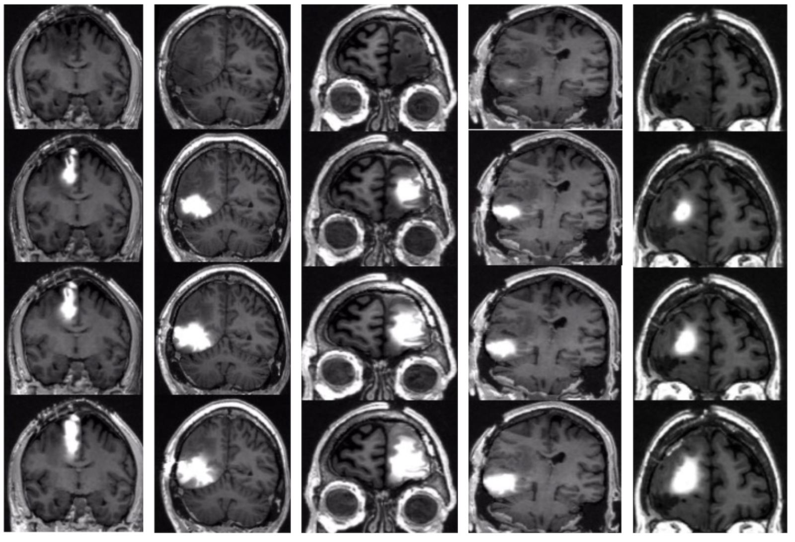 MRI scans showing the areas of the brain where chemotherapy drug accumulated