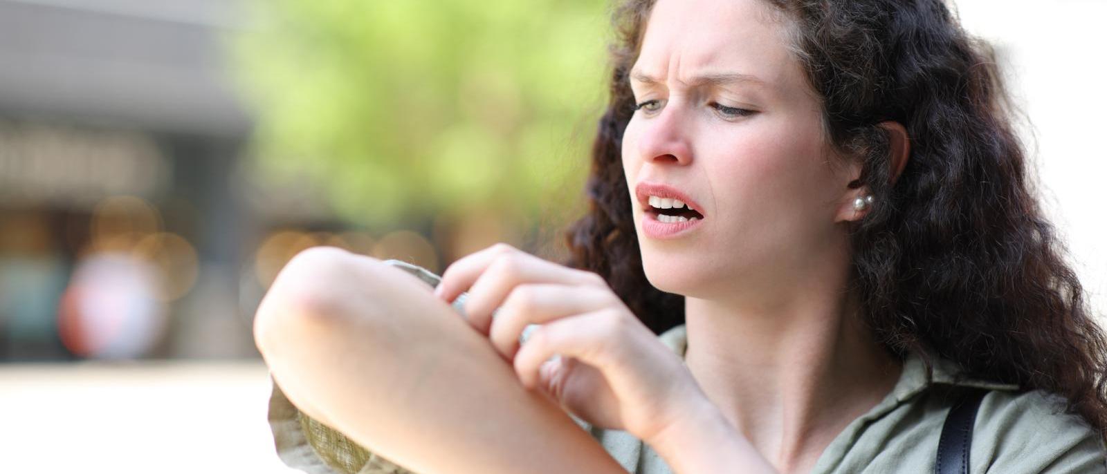 How to Stop Bug Bites from Itching Columbia University Irving Medical Center