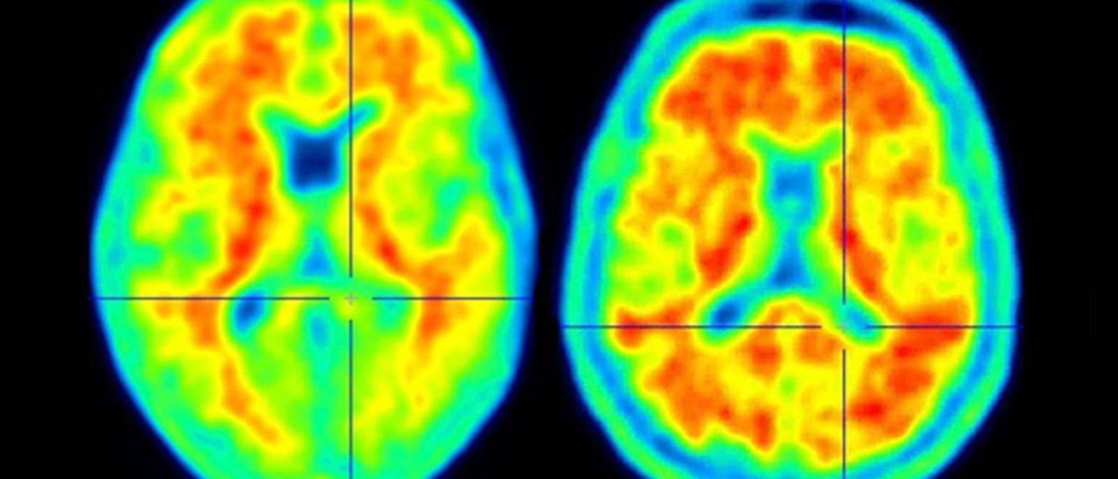 Newly Found Genetic Variant Defends Against Alzheimer’s Disease