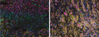 glioblastoma samples before immunotherapy treatment glioblastoma samples before immunotherapy treatment