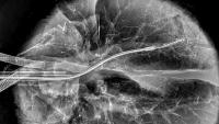 catheter inside lung