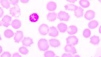 red blood cells infected with malaria parasite