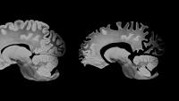 two medical images showing brain loss in Alzheimers disease