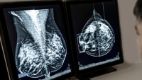 mammogram images on computer screen