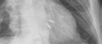 chest radiograph showing two MitraClips in the heart