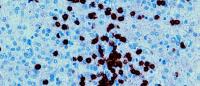 In NF-1 gliomas, the presence of immune cells (black) in the tumor suggest immunotherapy could be effective in treating the tumors. Image from Antonio Iavarone / Columbia University