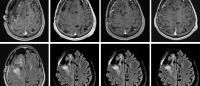 MRI imaging of glioblastoma patients who responded to immunotherapy