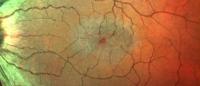 an image of a retina affected by MacTel disease