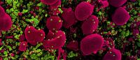 colorized human cells (pink) heavily infected with SARS-COV-2 virus particles (green) / NIAID