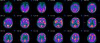 images from PET scan of human brain