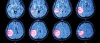 medical scan of brain tumor / Getty Images
