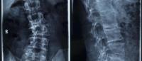 x-ray of a person with a curved spine