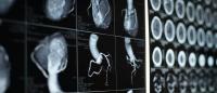 medical images of coronary arteries