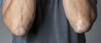 man with scaly skin patches on both elbows