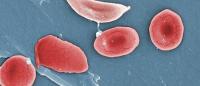 normal and sickled red blood cells