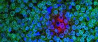 treatment resistant breast cancer cells