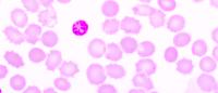 red blood cells infected with malaria parasite