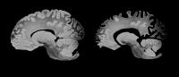 two medical images showing brain loss in Alzheimers disease