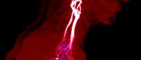 MRA scan shows arteries in the neck